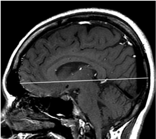 Standardní protokol MRI mozku (pro vstupní a rutinní každoroční screening všech pacientů): Síla pole skeneru >1,0 T, tloušťka řezu <5 mm bez mezer a s pokrytím celého mozku Axiální zobrazení ze