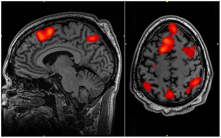 Analýzy ieeg signálu 11/38 funkční MRI