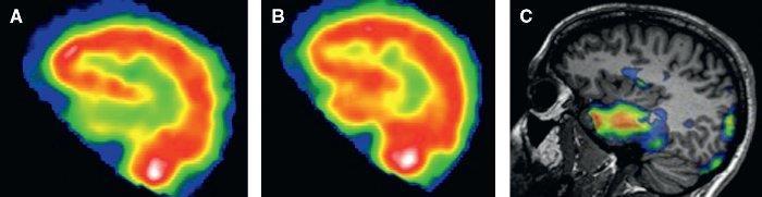 Analýzy ieeg signálu 14/38 SPECT / SISCOM Jednofotonová emisní tomografie Radiofarmakum, distribuce v tkáni v závislosti na metabolické