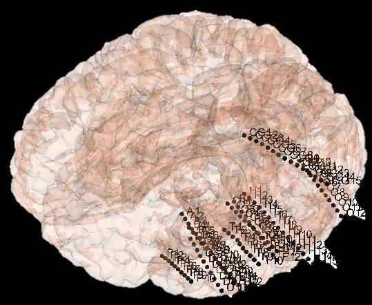 Analýzy ieeg signálu 21/38 Anatomická pozice kontaktů Přesná pizice až 250 kontaktů Anatomický atlas (struktura, tkáň.