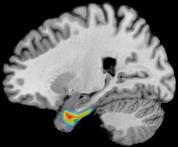 Amygdala (LB) Amygdala (LB)[76%]; Amygdala (SF)[24%]; A4 gray [100 %] Amygdala (LB) Amygdala (LB)[93%]; A5 gray [100 %] Amygdala (LB) Amygdala