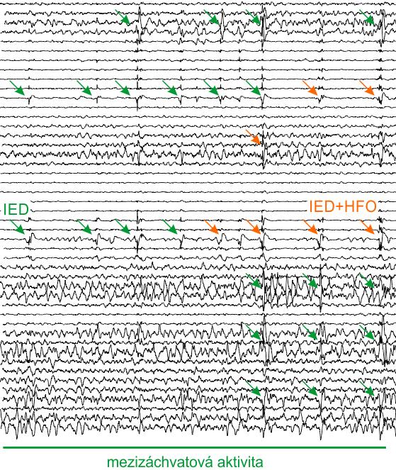 Analýzy ieeg signálu 24/38 Kvantitativní analýza EEG