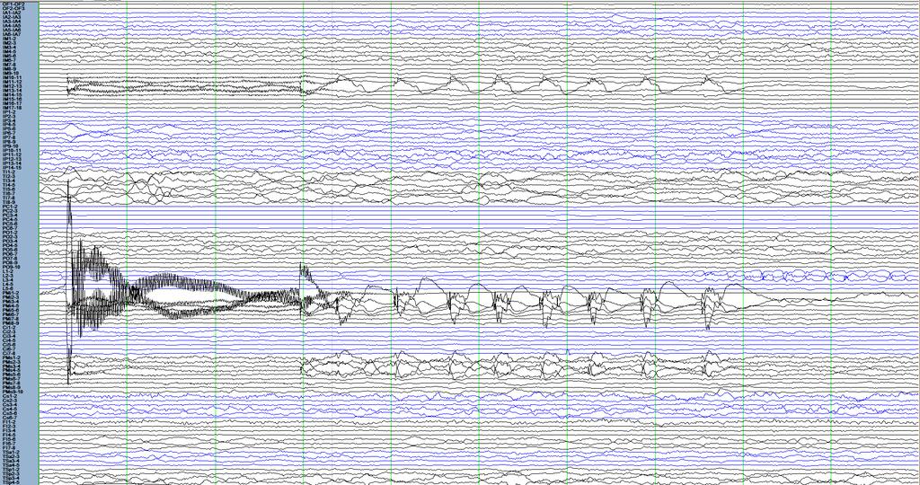 Analýzy ieeg signálu 31/38 Kortikální stimulace after