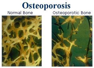 OSTEOPORÓZA Dle WHO: Progredující systémové