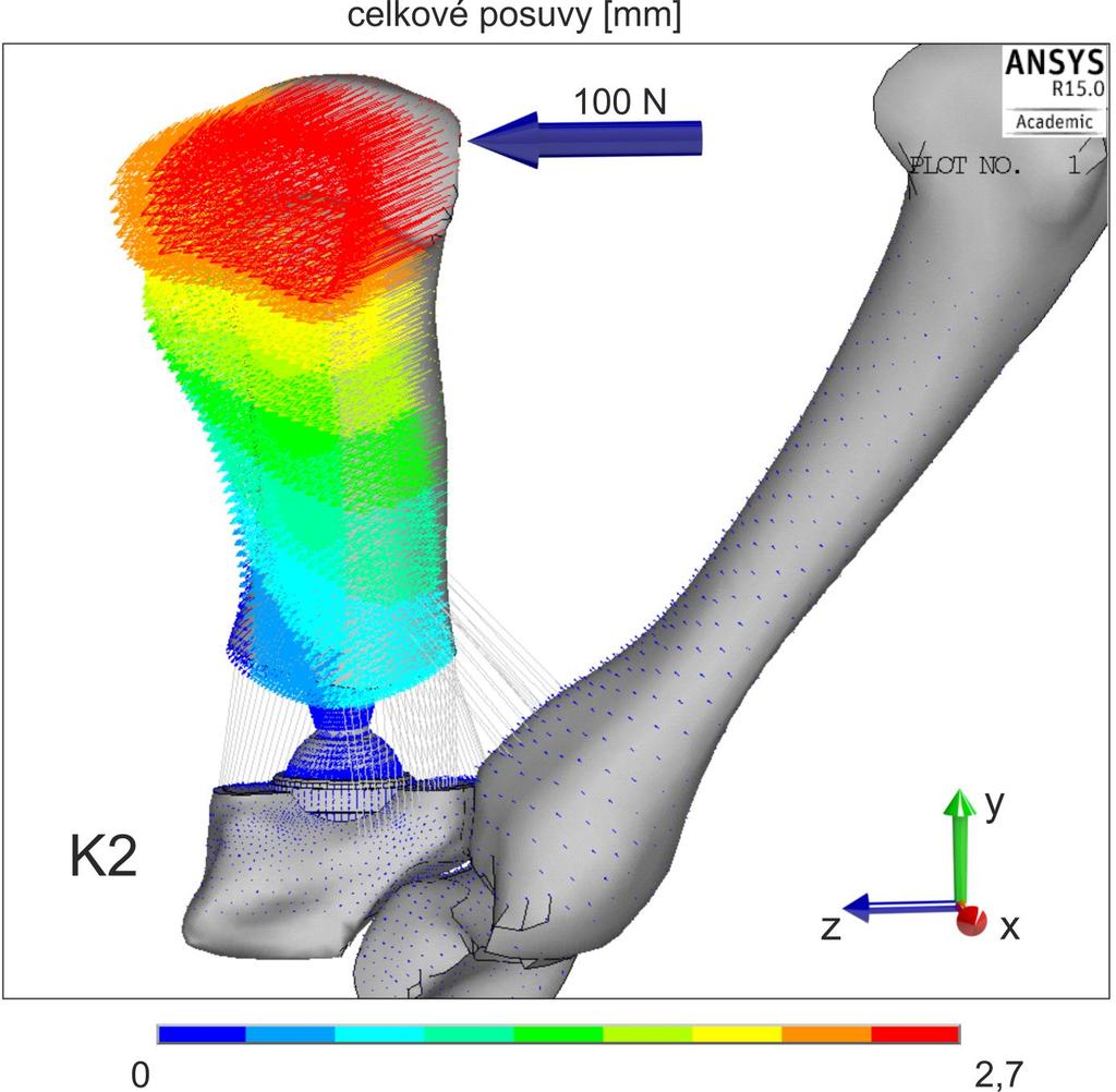 10.2 Prezentace a analýza výsledků náhrady TMC skloubení (D) Obr. 10.15: Celkové posuvy ilustrované na konfiguraci K2 Pro ilustraci celkových posuvů byla zvolena konfigurace K2.