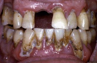 Gingivostomatitis: