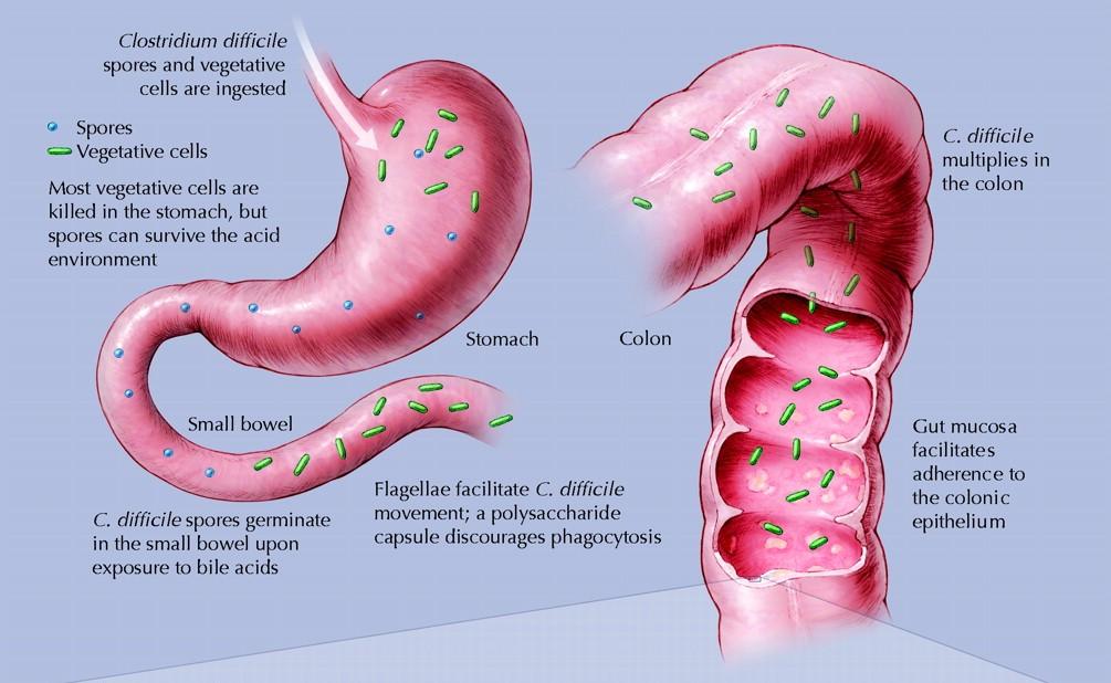 Clostridium difficile a jeho