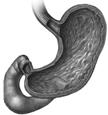 ENZYMŮ - YDROLÁZ Glutenase ALV003 Attenuates Gluten-Induced Mucosal Injury in Patients With Celiac Disease.