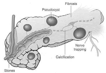 AKUTNÍ PANKREATITÍDA PATOGENETICKÉ SEKVENCE TRYPSINOGEN - TRYPSIN - SEKVENCE SPOUŠTĚCÍ