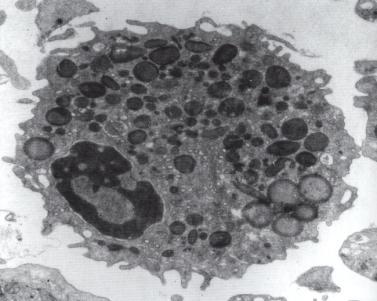 přítomností v tkáních i v BAL kde je většina hypodenzních eozinofilů, coţ je v souhlase s nálezem i v periferní krvi vyšší tvorbou IL-17 hypodenzními eozinofily, která byla prokázána v