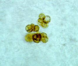 V postižené tkáni tvoří houby oválné pigmentované útvary se septy- tzv. sklerotická tělíska Původci řazeni mezi Dematiaceae (Fonseca pedrosoi, Phialophora verrucosa, Cladophialophora carrionii).