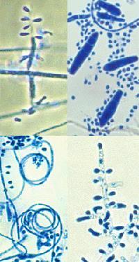 Onychomycosis T.