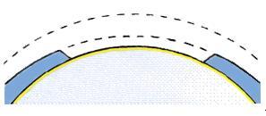 b) lamela pro DMAEK: Hybridní zadní rohovková lamela pro DMAEK (Descemet Membrane Automated Endothelial Keratoplasty) histologickou strukturou odpovídá lamele dr. Studeného pro DMEK-S.
