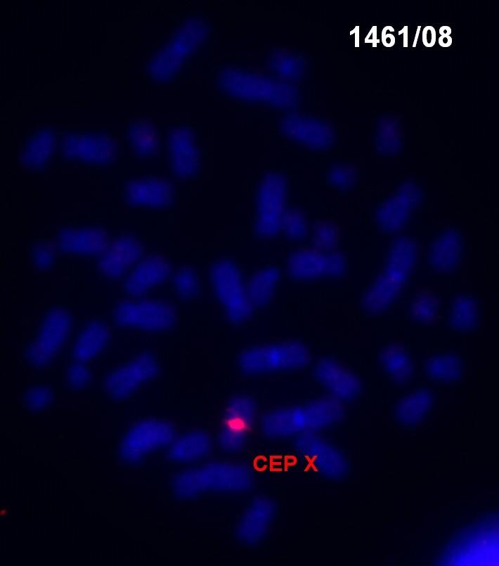 VROZENÉ CHROMOSOMOVÉ ABERACE (VCA) MOZAICISMUS