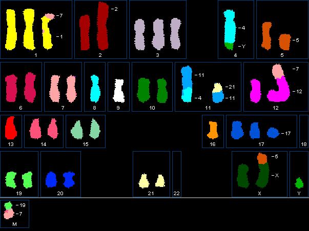 ONKOCYTOGENETIKA komplexní karyotyp 56,XY,der(X)t(X;5),+der(1),add(2),+3,der(4)t(4;?),+6?