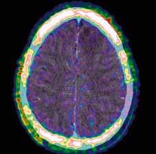 A CT; B PET/CT; C PET Obr. 2A Obr. 2B Obr. 2C Obr. 2D Obr. 2E Obr. 2F Obr. 2. Anaplastický astrocytom G3 vpravo frontálně.