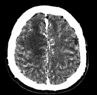 proliferačním indexem Fig. 2. Anaplastic astrocytoma G3 right frontal.