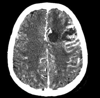 Obr. 3A Obr. 3B Obr. 3C Obr. 3. Glioblastoma multiforme G4 vlevo frontálně. A CT; B PET/CT; C PET Fig. 3. Glioblastoma multiforme G4 left frontal. A CT; B PET/CT; C PET Obr. 4A Obr.