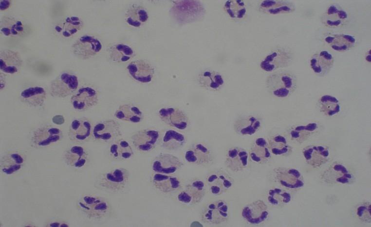 Typy cytologických likvorových nálezů Granulocytární pleocytóza s převahou neutrofilů se vyskytuje u