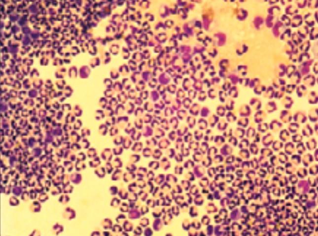 Bakteriální zánět Počet granulocytů vysoký (až tisíce) CB