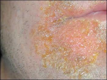či infekce kůže s krustami http://www.dermatology.co.
