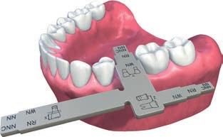 1 Diagnostické T pro Straumann Standard, Standard Plus a Tapered Effect implantáty Použitím Diagnostického T v ústech pacienta nebo na