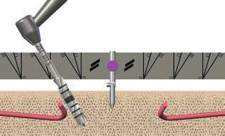 3.2.3 Plánování angulace implantátů s použitím Straumann Pro Arch šablony Straumann Pro Arch šablona se používá pro vizuální a trojrozměrnou orientaci sklonu implantátu (mesiální/distální) a orální