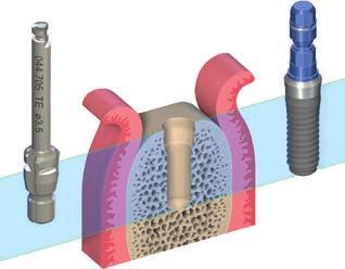 4.1.3 Příklady jemné preparace imlantačního lůžka pro implantáty Straumann Standard a Standard Plus 1 Krok 1 Standard Plus Profilová fréza Vypreparujte koronální část implantačního lůžka pomocí