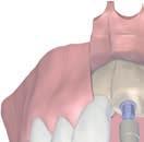 4 Krok 4 Není u implantátů S/SP/TE implantáty S, SP, and TE není třeba zavádět do správné pozice.