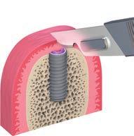 3 3 Krok 3 Znovuotevření: druhá operace Lokalizujte implantát Udělejte malý krestální řez směrem dolů k šroubku implantátu.