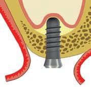 ѹ Během elevace aplikujte na lůžko implantátu take autologní a/nebo aloplastickou výplň nebo kostní materiál. Zavedený materiál funguje jako podklad zvedající sliznici v souladu s principy hydrauliky.