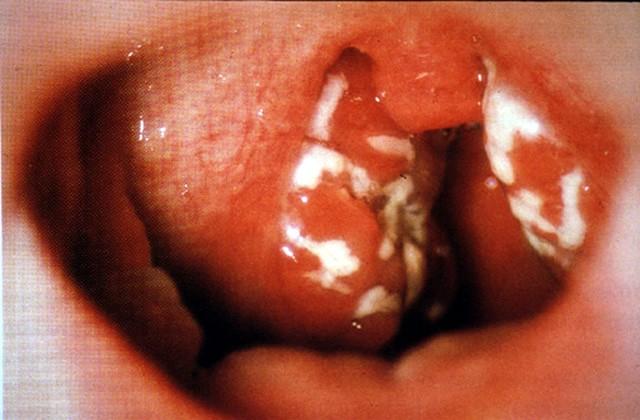 Purulentní (= hnisavá) bakteriální tonsilitis (angína) http://www.