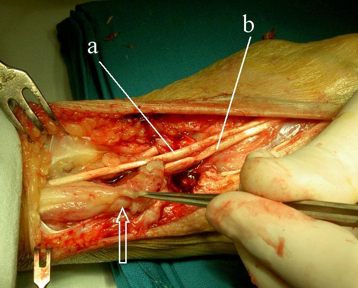 Obr. 1. Operační nález synovitidy extenzorů: šipka ukazuje šlacha extenzorů prstů s masivní tenosynovitidou, a/ m.