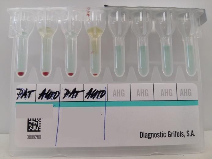 4.1.4 Přímý antiglobulinový test Název vyšetření na žádance: Přímý antiglobulinový test - PAT Vyšetřovaný materiál: Erytrocyty Odběr do: Plast s KxEDTA Manipulace s materiálem (transport): Odebraný