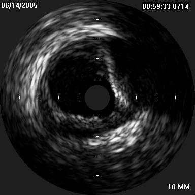 Příloha P: Fibrokalcifikovaný plát při intravaskulárním ultrazvuku