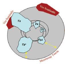 T staging T1 - mukóza a submukóza (EUS) T2 - muscularis propria T3 - přes muscularis propria do serózy či mezorekta T3a <5mm za musc. propria T3b >5mm za musc.