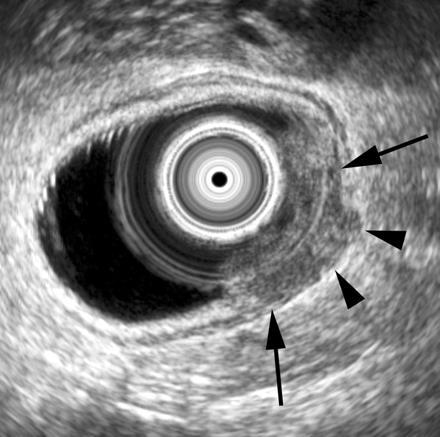 T staging EUS odliší T1 a T2, odliší lépe T2 od T3 invaze do perirektální tkáně senzitivita: EUS > MR > CT, specificity srovnatelné problematická při obturujících TU, vysoko uložených TU MR horší