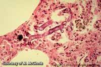 ZYGOMYKÓZA Je způsobována několika oportunními patogeny z řádu Mucorales (Zygomycota).