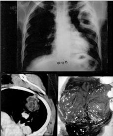 jpg Rhizopus arrhizus způsobující léze na plicích