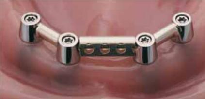 6.2.Kotvení na implantáty Implantáty nahrazují pilířové zuby a jejich kořeny. Implantáty nebo případně miniimplantáty lze kotvit i celkové zubní náhrady.