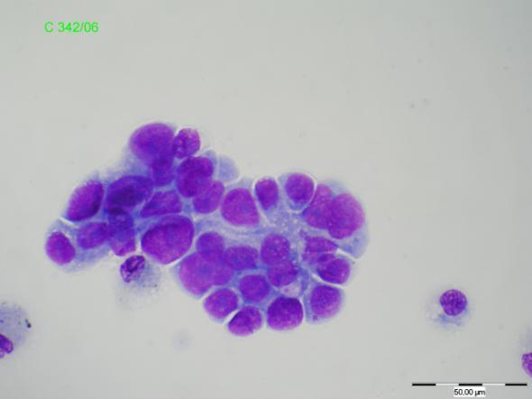 adenokarcinomu Obr.