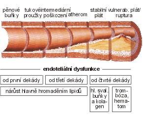 Obrázek č. 1 Endoteliální dysfunkce [74] Nejdříve detekovatelné aterosklerotické léze jsou lipoidní proužky. Tvoří je seskupení makrofágů bohatých na lipidy a T - lymfocyty uvnitř intimy.