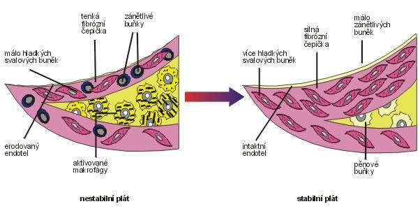 lézí cévní intimy. Buňky hladkého svalstva jsou zdrojem kolagenu a stabilizují aterom a snižují riziko jeho ruptury a tvorby trombu. Obrázek č.