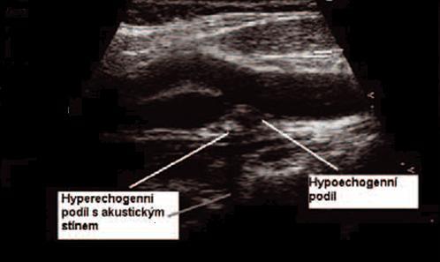 Obrázek č. 6 Ultrasonografie karotid [65] Ultasonografické vyšetření - zobrazení aterosklerotického plátu v bifurkaci cévy.