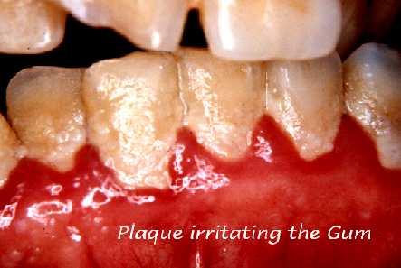 5. Zubní plak 5.1. Charakteristika Zubní mikrobiální plak je získaný měkký povlak, který pokrývá plochy zubu s nedostatečným samoočišťováním při nedokonale prováděné ústní hygieně (Škach, 1984).