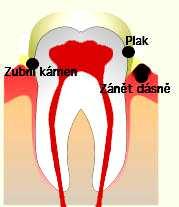 5.5.1. Tvorba zubního kamene Zubní kámen se tvoří ze zubního plaku, na kterém se ukládají minerální látky (rozpuštěné soli) ze slin a zbytků potravin.