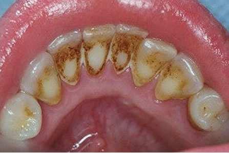 2) Subgingivální zubní kámen je tmavý a tvoří se v parodontálních chobotech. Subgingivální kámen je tvrdý a pevně lpí na povrchu zubu. Zdrojem vápníku pro mineralizaci je zde gingivální tekutina (Obr.