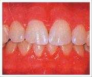 Ze zubního kamene se uvolňují látky, které dráždí dásně a ty jsou pak zčervenalé, oteklé a mohou se i zanítit. Takto vznikají záněty dásní, neboli gingivitidy (Obr. 25). Obr.