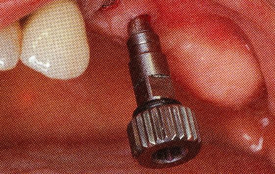Obr. 33: Náhrada (zubní implantát).