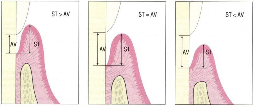 3.1.5.1.2.4 Ztráta attachmentu Při měření ztráty attachmentu slouží jako retenční body cementosklovinná hranice a sondovatelné dno parodontálního chobotu.